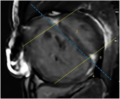 Right ventricular fibrosis in adults with uncorrected secundum atrial septal defect and pulmonary hypertension: a cardiovascular magnetic resonance study with late gadolinium enhancement, native T1 and extracellular volume